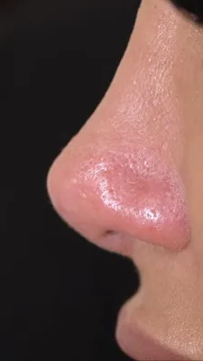 Non-Surgical Rhinoplasty