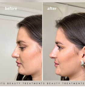 Non-Surgical Rhinoplasty
