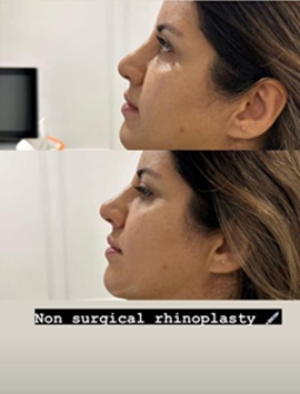 Non-Surgical Rhinoplasty