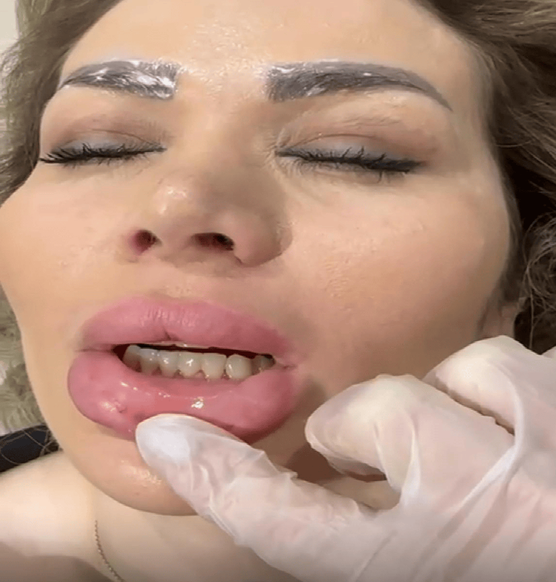 Dissolving Treatment