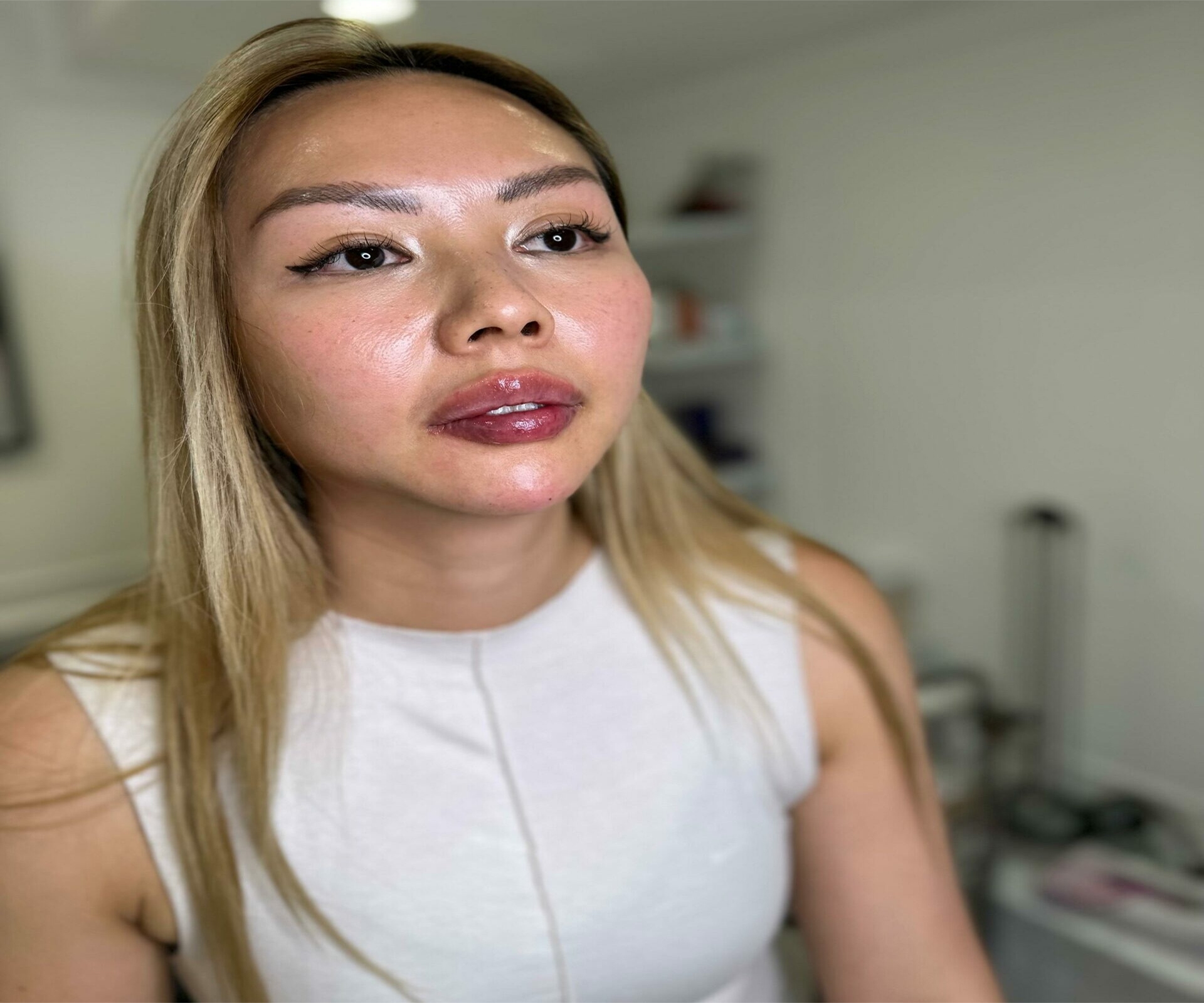 Jawline and Chin Fillers