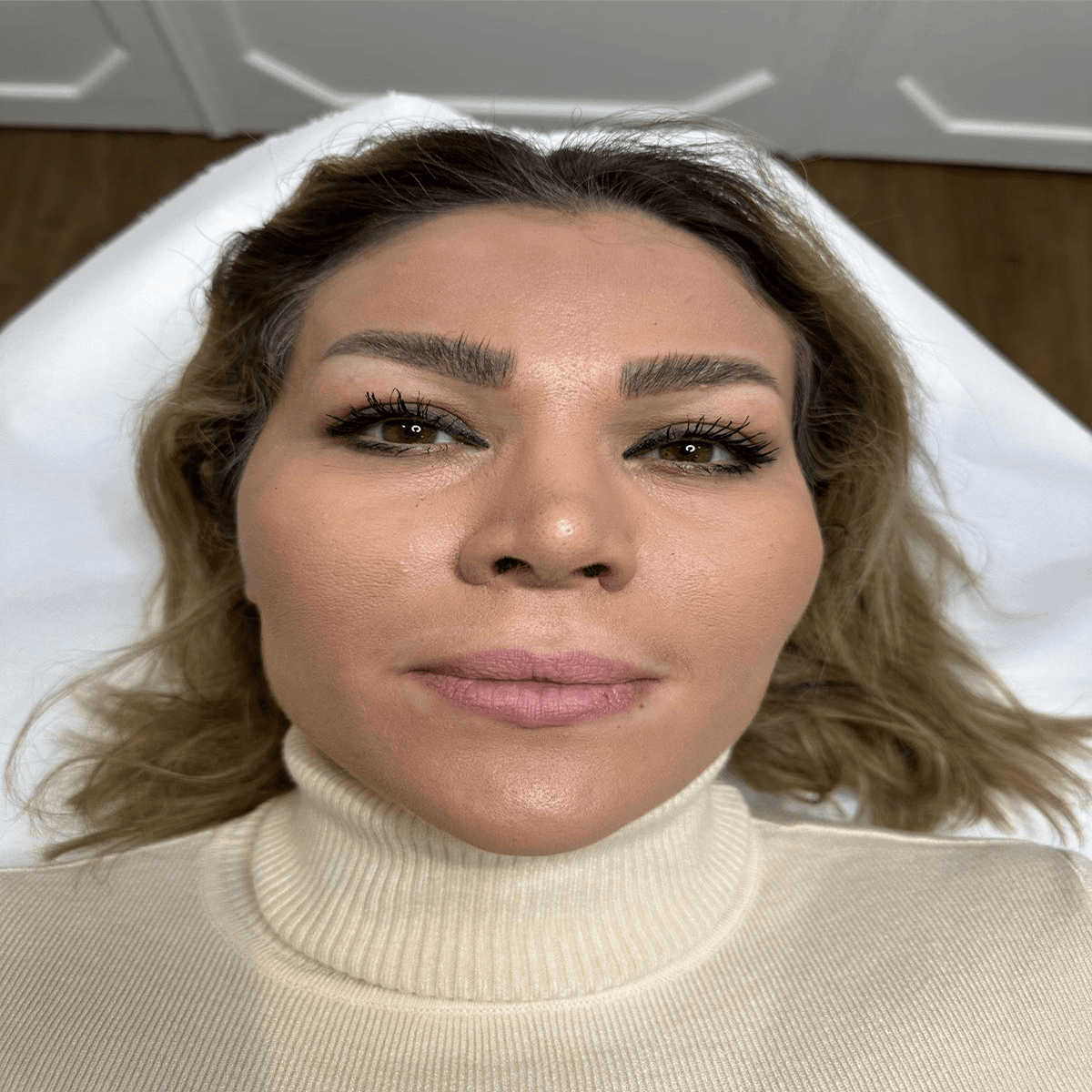 Why You Might Need to Dissolve Filler