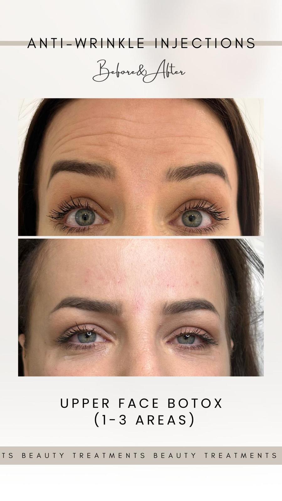  Anti-Wrinkle 1-2-3 Zone Treatment